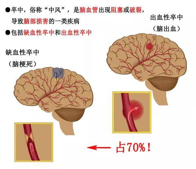 大幅降溫一定要警惕卒中