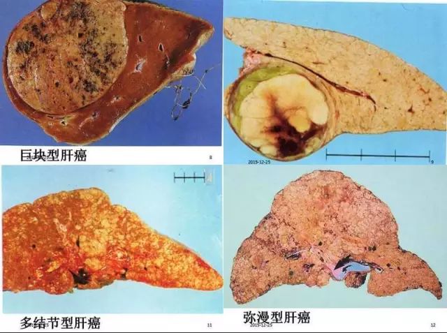 重慶男子狂奔9小時逃出緬北